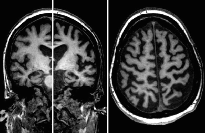 Pszilocibin az Alzheimer-kórban: csoda helyett óvatosság